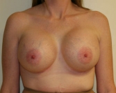 Feel Beautiful - Breast Augmentation San Diego Case 49 - After Photo
